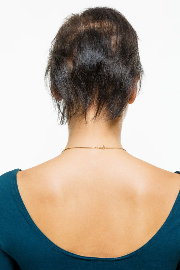 d&uuml;nnes Haar ohne Tritec-Hair<sup>&reg;</sup>